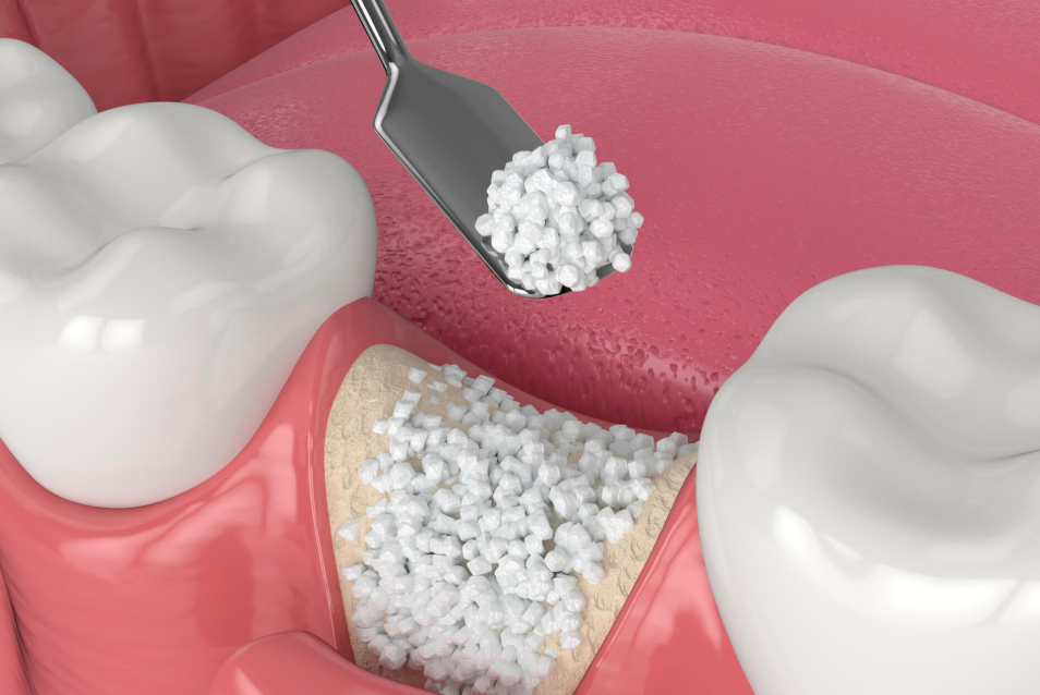 Bone Grafts